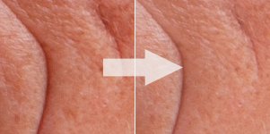 remove skin wrinkles