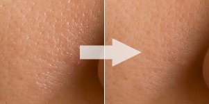 remove skin pores