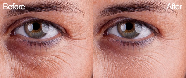 eye-bag, crow's feet